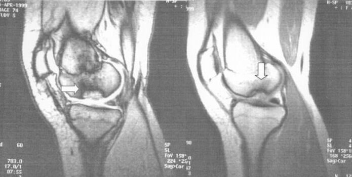 рентгенова снимка на остеохондроза dissecans в колянната става