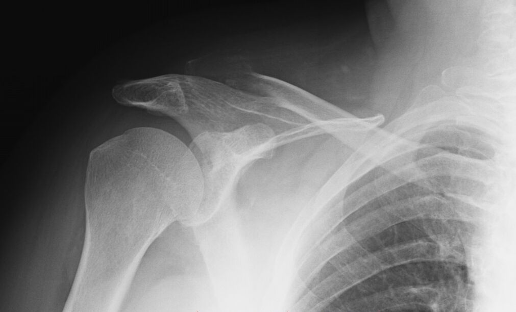 рентгенова снимка на артроза на рамото
