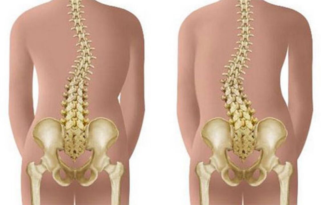 сколиоза като причина за болки в гърба в областта на лопатките
